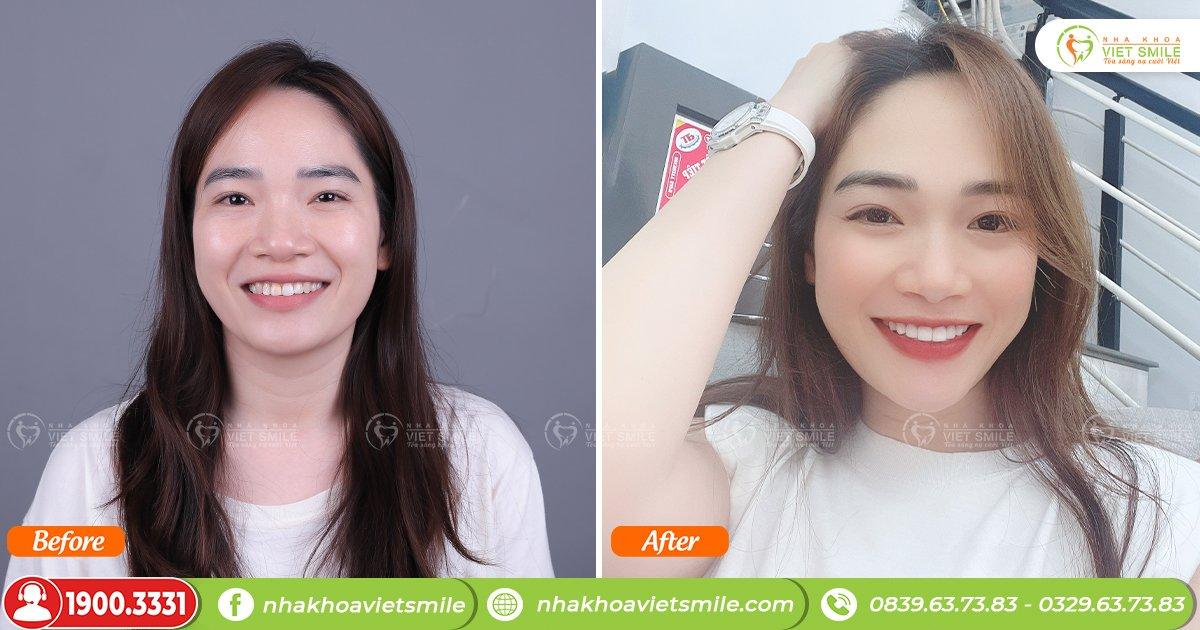 Giải pháp sẽ được đưa ra tùy vào từng tình trạng của mỗi người