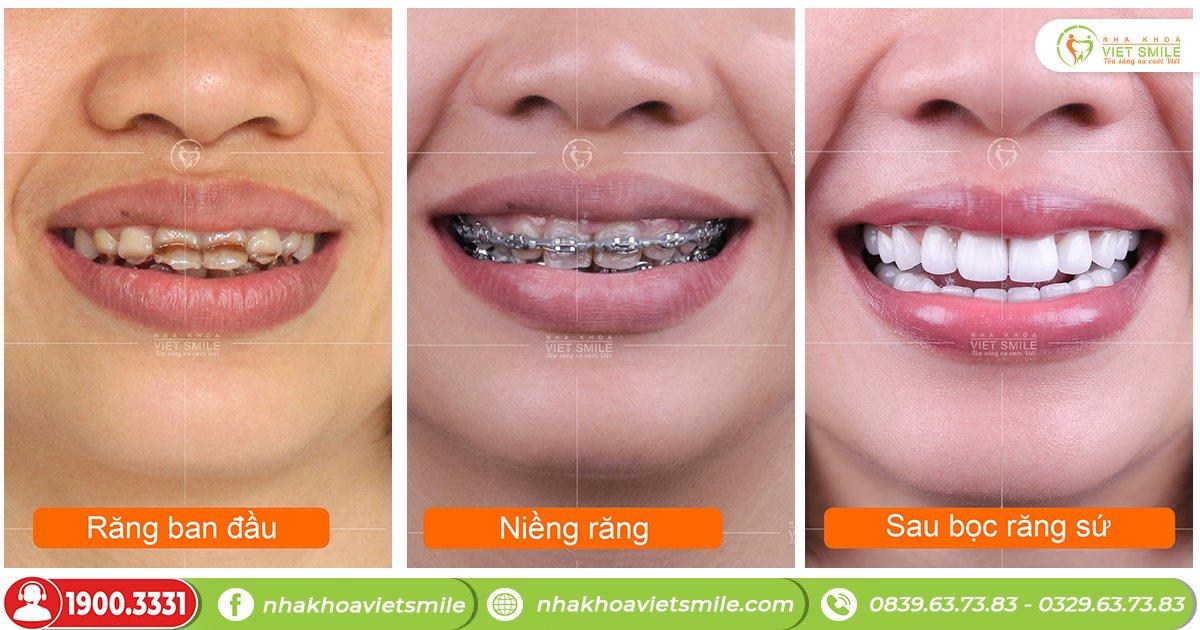 VIET SMILE - Điểm đến tin cậy về dịch vụ chăm sóc răng miệng
