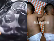 Bà bầu - Cặp sinh đôi "đánh nhau" từ trong bụng mẹ, chào đời cơ thể có nhiều vết bầm tím?