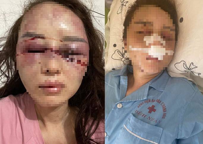Hình ảnh chị V. bị Lê Trọng Nhạc đánh dã man gây thương tích nặng - Ảnh gia đình cung cấp