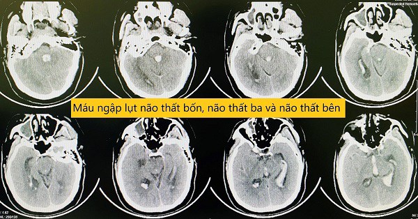 Hình ảnh máu ngập lụt trong não bệnh nhân. Ảnh: BSCC.
