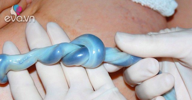 Đỡ đẻ cho mẹ bầu 21 tuổi, bác sĩ phát hiện dây rốn thai nhi... buộc thắt nút