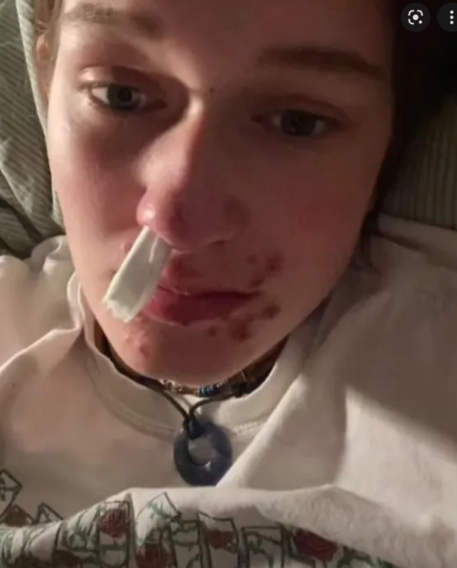 Camiilla đã bị mụn rộp ở môi do lây truyền từ chàng trai mà cô đã hôn.