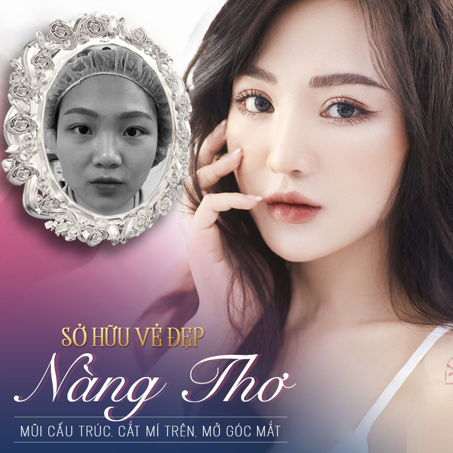 Hình ảnh khách hàng T.T sau 9 tháng thực hiện Nâng mũi - Cắt mí tại Bác sĩ Doãn Lâm