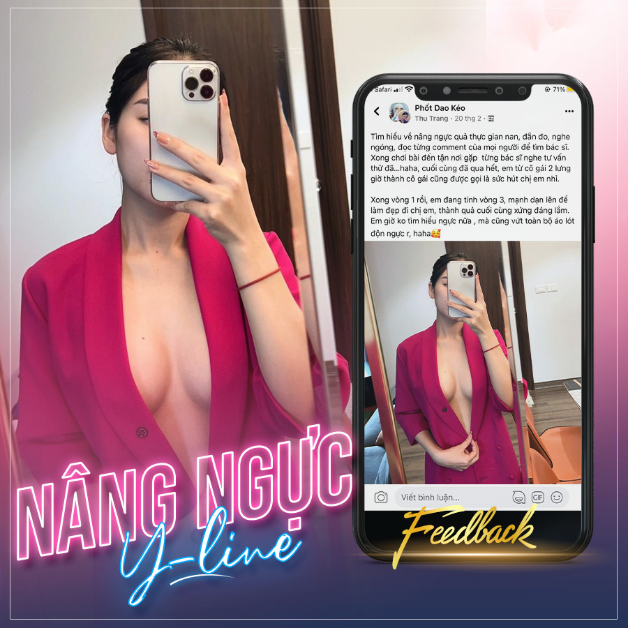 Hình ảnh khách hàng N.A sau 3 tháng thực hiện Nâng ngực tại Bệnh viện được cấp phép