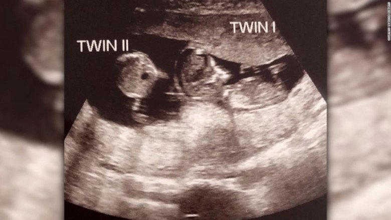 Đang mang thai 3 tháng, mẹ bầu đi siêu âm tá hỏa biết có thêm 1 bé nữa trong tử cung - 1