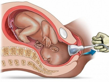 Rặn đẻ mãi không được nên phải sinh con bằng giác hút, mẹ lo sau này con gặp rủi ro