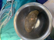 Sức khỏe - Ăn quả hồng đầu thu, người phụ nữ phải nhập viện phẫu thuật gấp