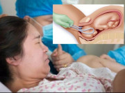 Bà bầu - Cổ tử cung mở hết nhưng không rặn đẻ được, bác sĩ phải dùng kẹp lấy con ra khiến đầu bé méo xệch, toàn thân tím tái