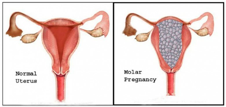 Mới bầu vài tuần bụng đã phình to, đi siêu âm không có phôi, bác sĩ nói đang mang thai amp;#34;chùm nho” - 6