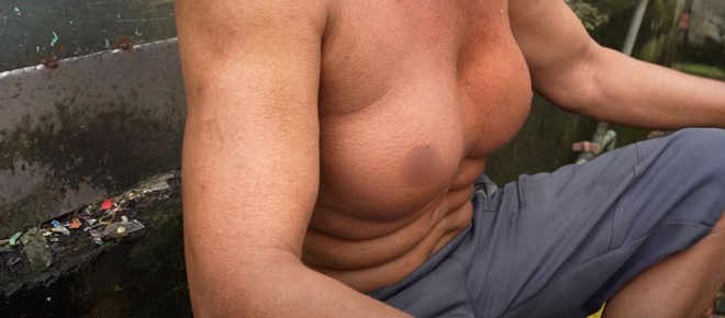 Người đàn ông Bình Dương sở hữu vòng 1 amp;#34;siêu khủngamp;#34;, nguyên nhân đến giờ vẫn chưa thể lý giải nổi - 3