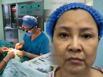 Người phụ nữ 50 tuổi ngại phẫu thuật, dùng sợi chỉ căng da, giờ phải rạch một đường lớn trên mặt, kết quả ra sao?