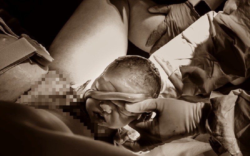 Bác sĩ gỡ dây rốn quấn cổ cho em bé.
