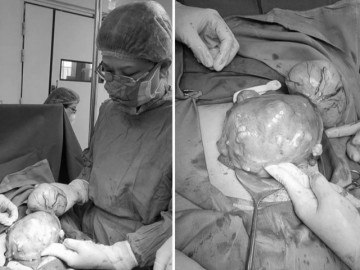 Kinh nguyệt quá nhiều, người phụ nữ đi khám phát hiện u xơ tử cung to bằng thai nhi 5 tháng