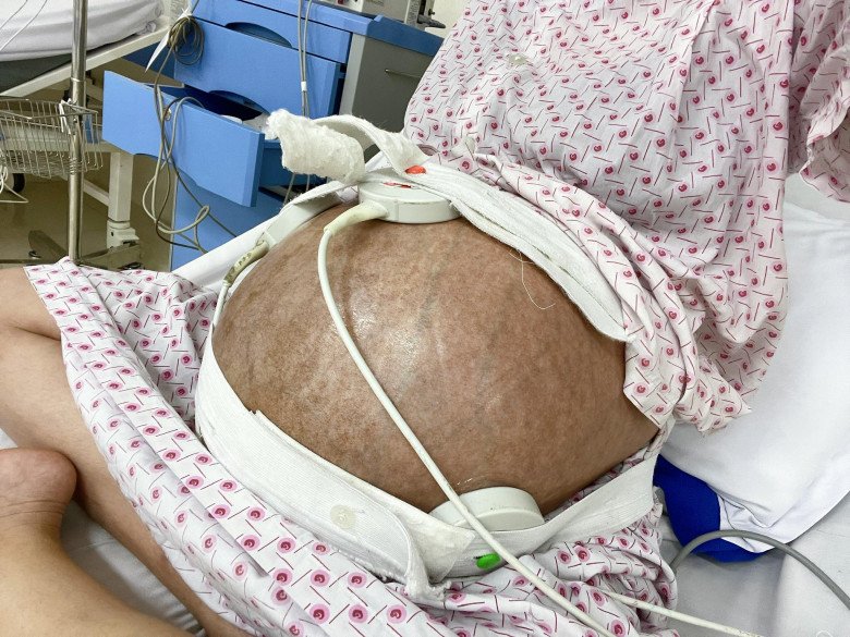 View - Mẹ bầu song thai bị rạn da chằng chịt, sau sinh 1 năm vẫn ám ảnh đến mức không dám đi mua đồ