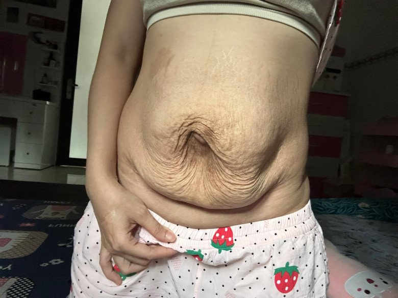View - Mẹ bầu song thai bị rạn da chằng chịt, sau sinh 1 năm vẫn ám ảnh đến mức không dám đi mua đồ