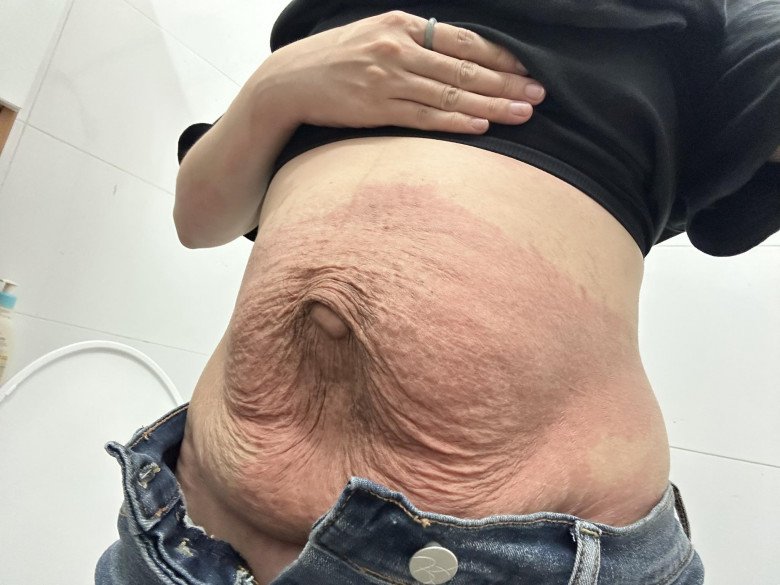 View - Mẹ bầu song thai bị rạn da chằng chịt, sau sinh 1 năm vẫn ám ảnh đến mức không dám đi mua đồ