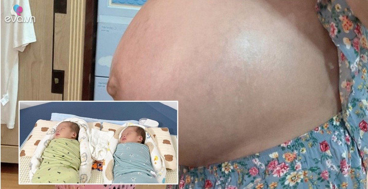 View - Mẹ bầu song thai bị rạn da chằng chịt, sau sinh 1 năm vẫn ám ảnh đến mức không dám đi mua đồ