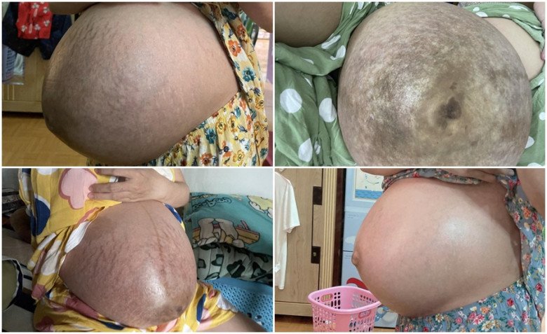 View - Mẹ bầu song thai bị rạn da chằng chịt, sau sinh 1 năm vẫn ám ảnh đến mức không dám đi mua đồ