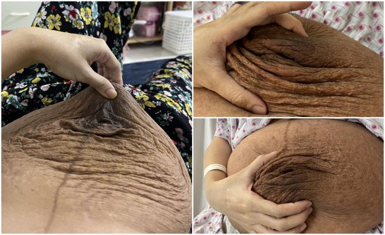 View - Mẹ bầu song thai bị rạn da chằng chịt, sau sinh 1 năm vẫn ám ảnh đến mức không dám đi mua đồ