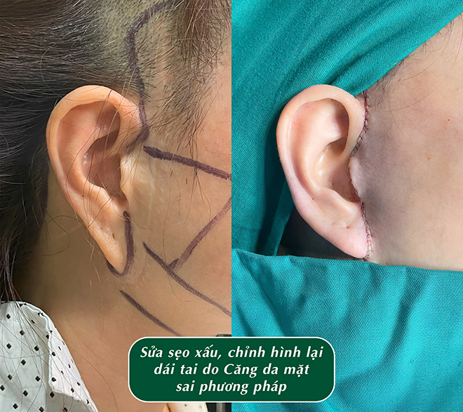 Bs CKII  Đỗ Thành Nghĩa với phương pháp căng da mặt dưới SMAS - 2