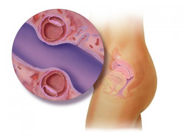 Dấu hiệu sớm cho thấy bạn mang thai đôi trước khi siêu âm và những lưu ý khi bầu song thai