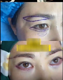 Lần đầu cắt bọng mắt và nâng chân mày, người phụ nữ U60 than đau đớn, nhìn kết quả thấy xứng đáng - 4