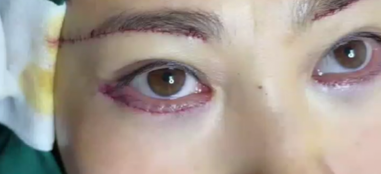 Kết quả phẫu thuật khiến người phụ nữ rất hài lòng. Dù vết thương chưa lành nhưng cô tự nhận xét bản thân trông như trẻ ra 10 tuổi.