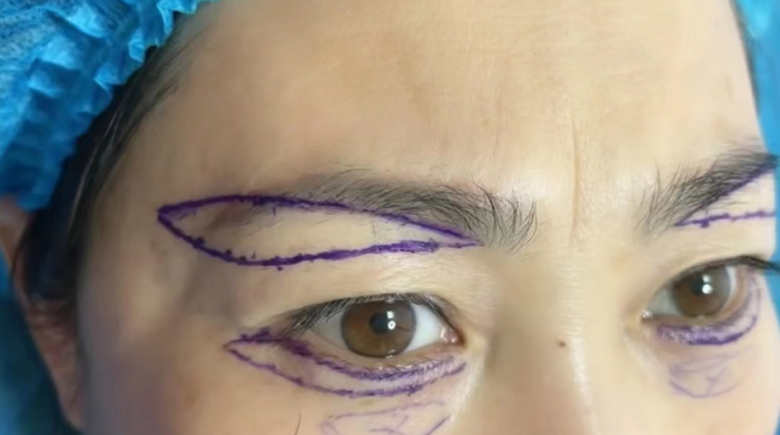 Phương án phẫu thuật được bác sĩ đưa ra: cắt da thừa để loại bỏ bọng mắt dưới + nâng cung chân mày trẻ hóa vùng mắt.