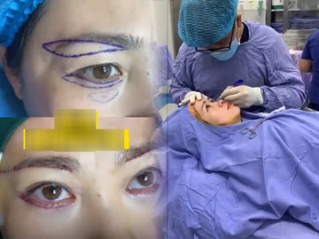Lần đầu cắt bọng mắt và nâng chân mày, người phụ nữ U60 than đau đớn, nhìn kết quả thấy xứng đáng