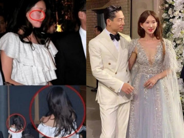 Ngôi sao 24/7: Đệ nhất chân dài dính tin mặt bầm tím, mũi vẹo, phải nhập viện vì bị chồng bạo hành