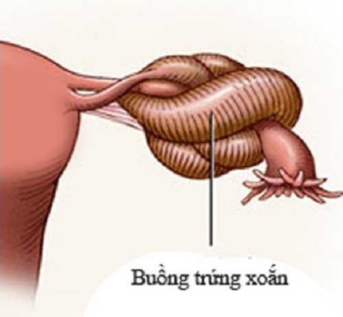 5 điều phụ nữ nên biết về xoắn buồng trứng để không ảnh hưởng đến khả năng sinh sản - 1