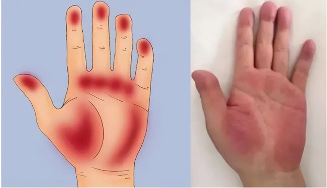 Người đàn ông sững sờ khi biết lá gan amp;#34;xơ như mướpamp;#34;, hóa ra vì suốt 10 năm kiên trì uống thứ này để khỏe hơn - 3