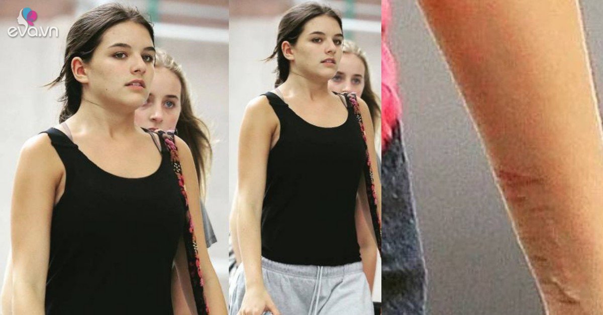 View - Suri Cruise - gây hoang mang khi lộ vết thương ở cổ tay, hình ảnh mới nhất lộ tình trạng hiện tại