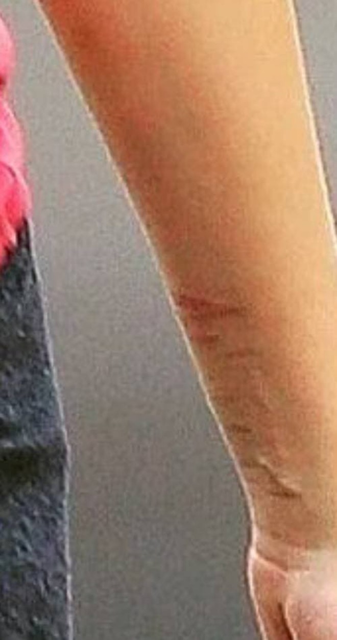 View - Suri Cruise - gây hoang mang khi lộ vết thương ở cổ tay, hình ảnh mới nhất lộ tình trạng hiện tại