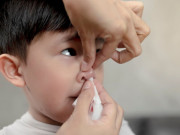 Sức khỏe - Bé trai 3 tuổi nguy kịch tính mạng vì bà nội xử lý theo cách dân gian khi cháu bị chảy máu cam