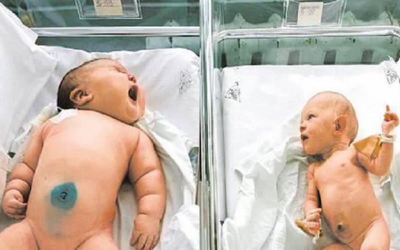 Em bé này sinh ra tại một bệnh viện ở Ấn Độ nặng 18kg, là con của một sản phụ người Australia, phá vỡ kỷ lục trẻ sơ sinh nặng nhất thế giới kéo dài gần 180 năm qua.
