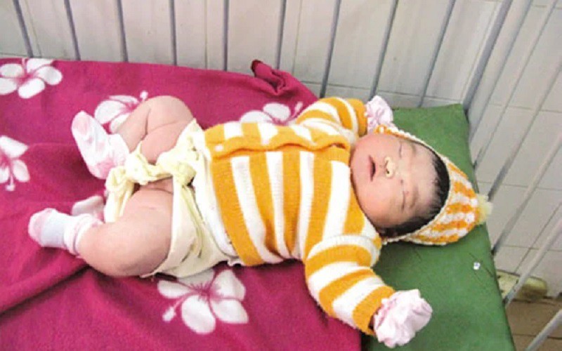 Bé gái ở Gia Lai với cân nặng lên tới 7kg. Trước khi lên bàn sinh, mẹ của bé nặng 90kg, tăng 26kg so với trước khi mang bầu.

