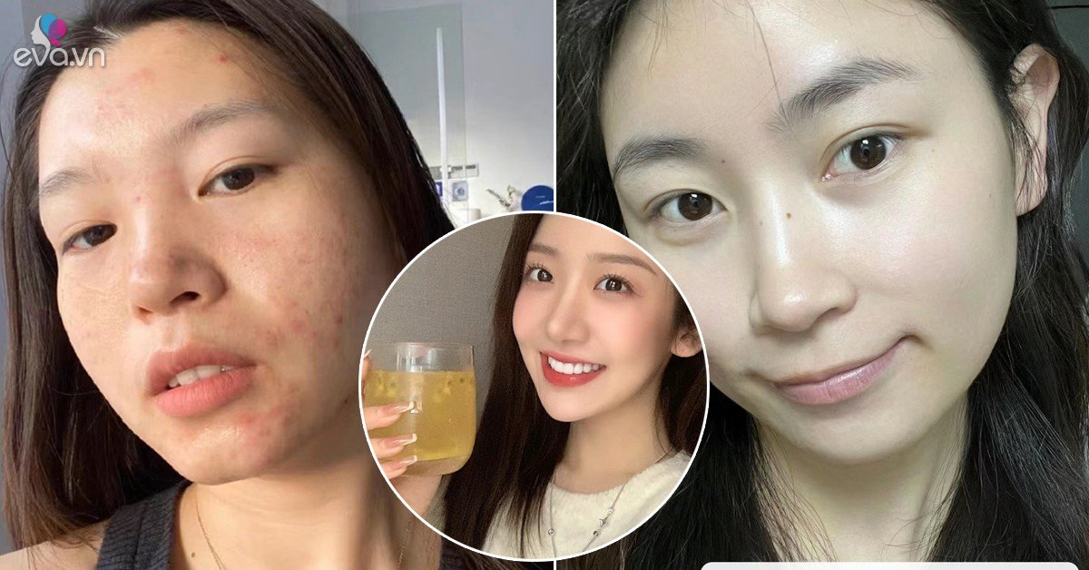 View - Không cần kem trị mụn tiền triệu, uống 4 loại nước hoa cỏ bình dân, da mặt nhẵn thín đẹp từ trong ra ngoài