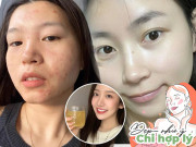 Làm đẹp - Không cần kem trị mụn tiền triệu, uống 4 loại nước hoa cỏ bình dân, da mặt nhẵn thín đẹp từ trong ra ngoài