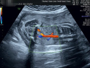 Bà bầu - Chuyện giờ mới kể về ca bệnh đột biến gene ACE lần đầu tiên được phát hiện tại Việt Nam