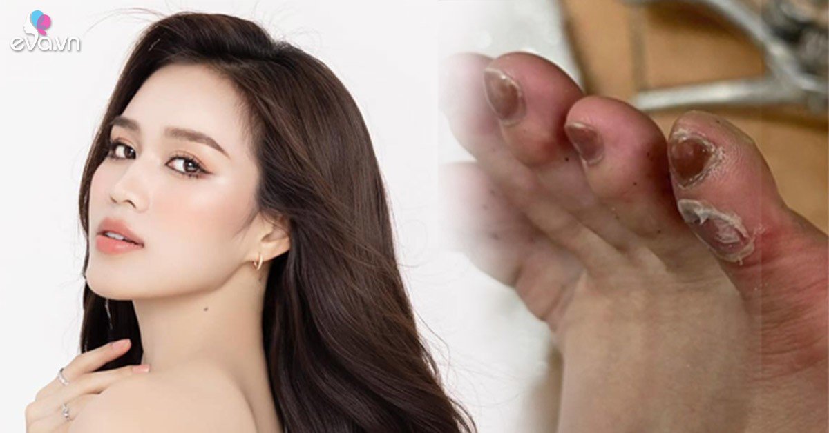 View - Đánh đổi vài phút lộng lẫy, Đỗ Thị Hà nhận cái kết thương tích đầy mình, móng chân bầm dập