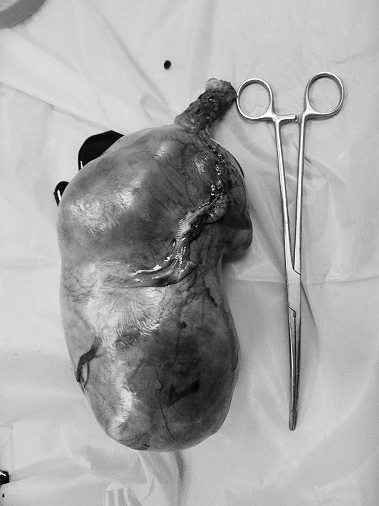 View - Bụng to nhanh như sắp đẻ, mẹ 1 con đi khám phát hiện khối u xơ tử cung nặng 4kg