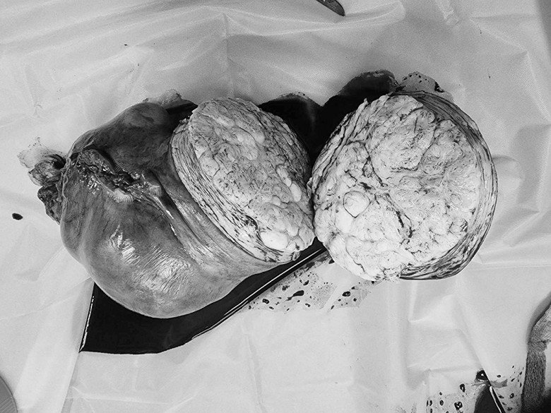 View - Bụng to nhanh như sắp đẻ, mẹ 1 con đi khám phát hiện khối u xơ tử cung nặng 4kg