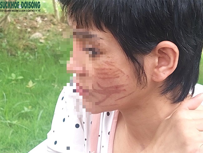 Vết thương chằng chịt trên mặt và cơ thể chị G. do chồng bạo hành