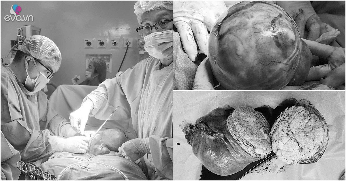 View - Bụng to nhanh như sắp đẻ, mẹ 1 con đi khám phát hiện khối u xơ tử cung nặng 4kg