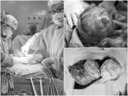 Bà bầu - Bụng to nhanh như sắp đẻ, mẹ 1 con đi khám phát hiện khối u xơ tử cung nặng 4kg