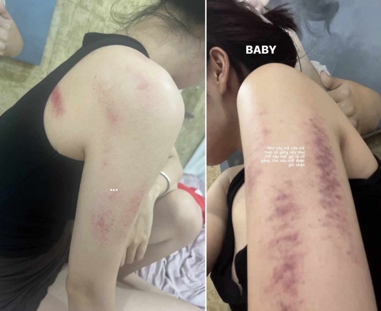 Người xem đoán rằng đây là dấu vết của việc đánh gió.