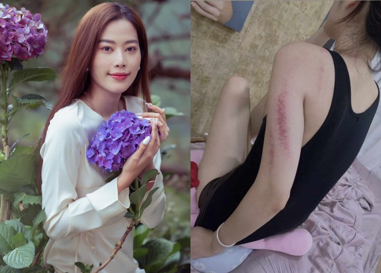 Người đẹp gây hoang mang khi đăng ảnh cánh tay có nhiều vết bầm.