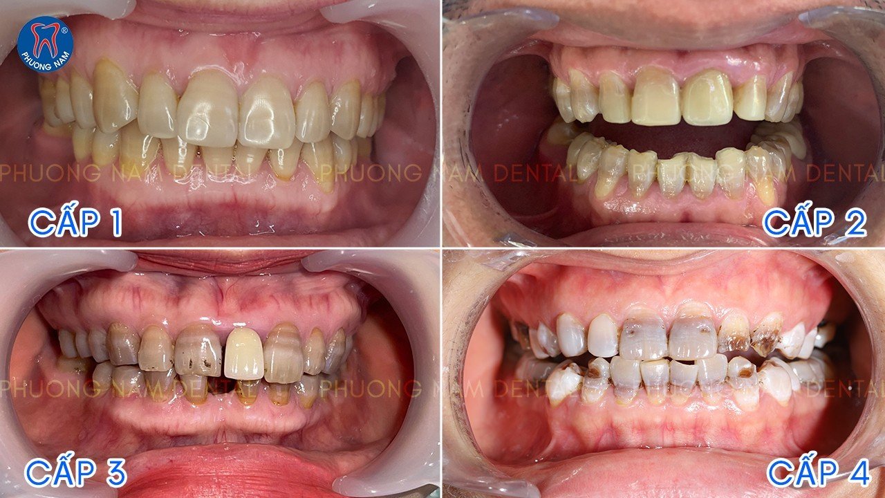 Các mức độ nhiễm Tetracycline trên răng